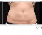 Tummy Tuck in Dubai
