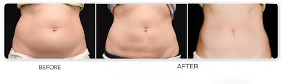 Tummy Tuck in Dubai